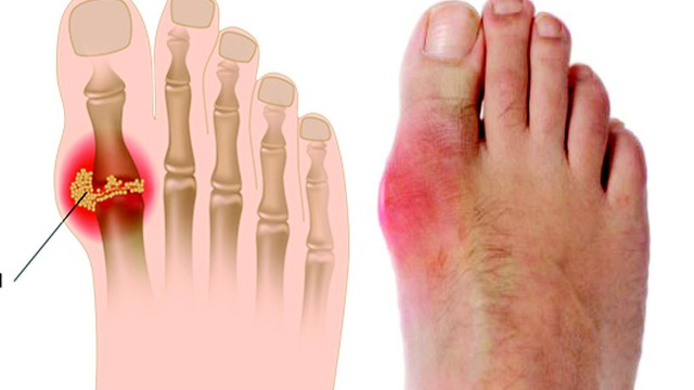 XUA TAN NỔI ĐAU DO GOUT MANG LẠI tri-gout